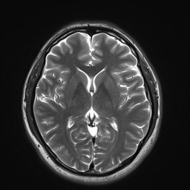 МРТ здорового головного мозга фото